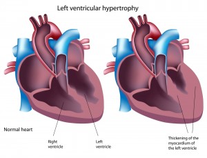 Hypertrophic Cardiomyopathy (HCM) - Australian Genetic Heart Disease ...