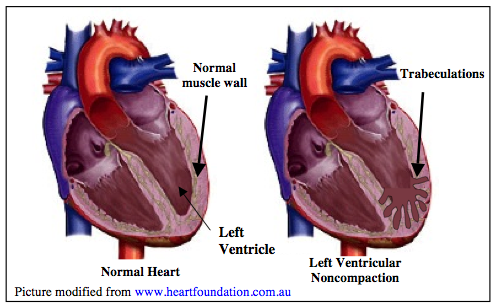 Left Ventricular Noncompaction (LVNC) - Australian Genetic Heart ...